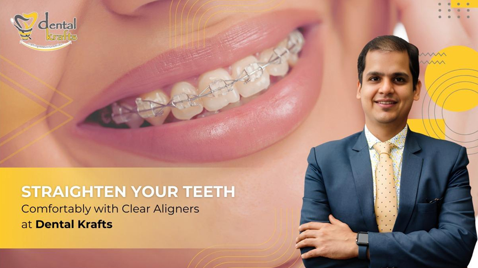 Straighten Your Teeth Comfortably with Clear Aligners at Dental Krafts